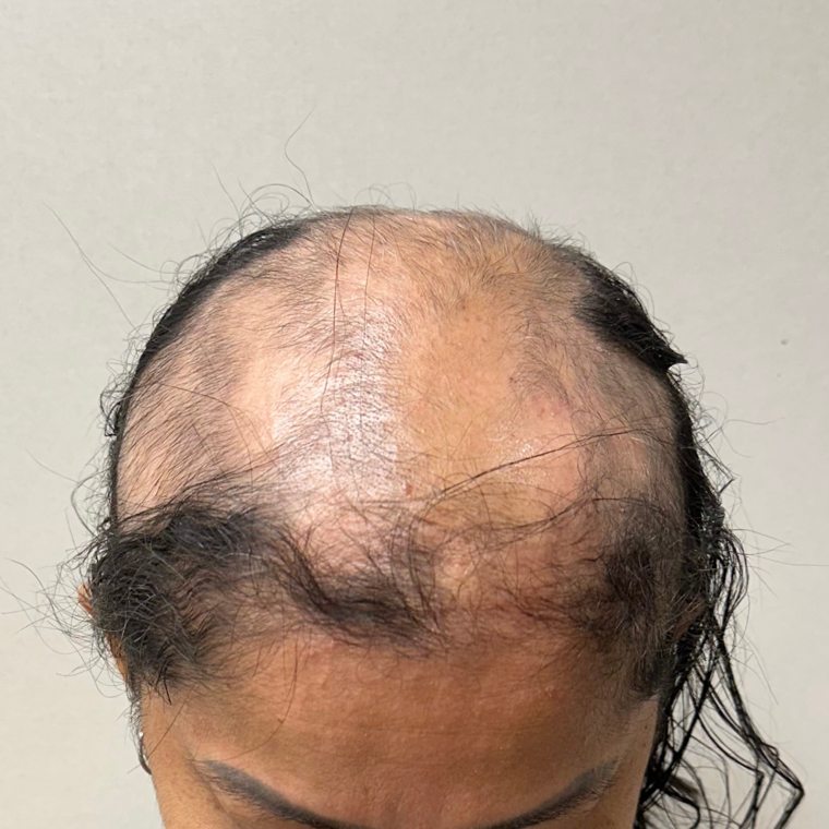 Tratamento para alopecia areata — antes