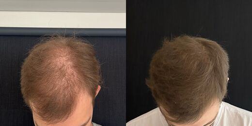 Resultado de tratamento capilar 2 — antes e depois