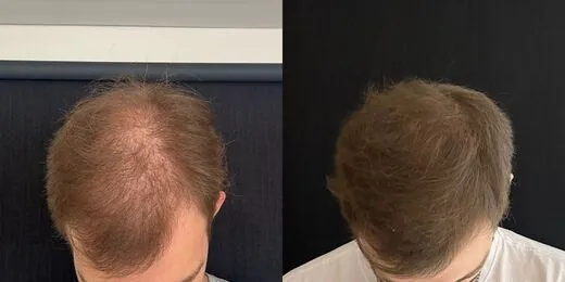 Resultado de tratamento capilar 2 — antes e depois