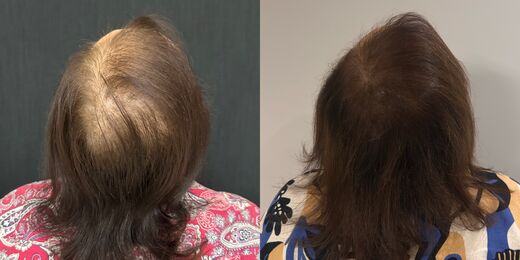 Resultado de tratamento capilar 3 — antes e depois