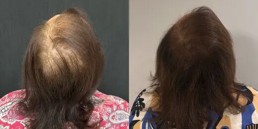 Resultado de tratamento capilar 3 — antes e depois