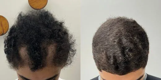 Resultado de tratamento capilar 4 — antes e depois