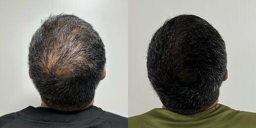 Resultado de tratamento capilar 5 — antes e depois