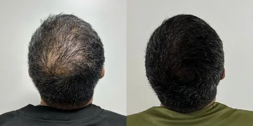 Resultado de tratamento capilar 5 — antes e depois