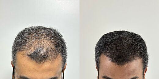 Resultado de tratamento capilar 6 — antes e depois