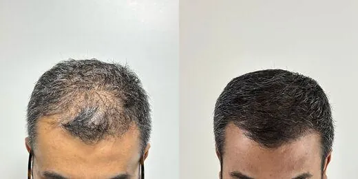Resultado de tratamento capilar 6 — antes e depois