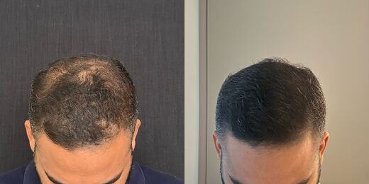 Resultado de tratamento capilar 7 — antes e depois