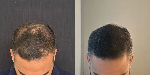 Resultado de tratamento capilar 7 — antes e depois