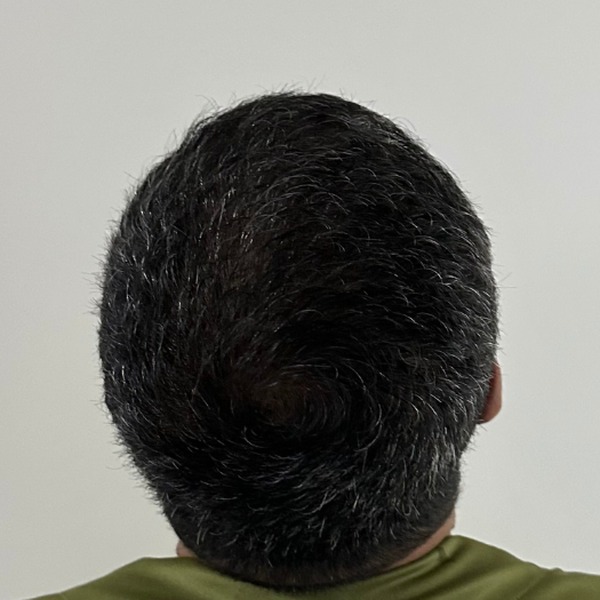 Tratamento para calvície — depois