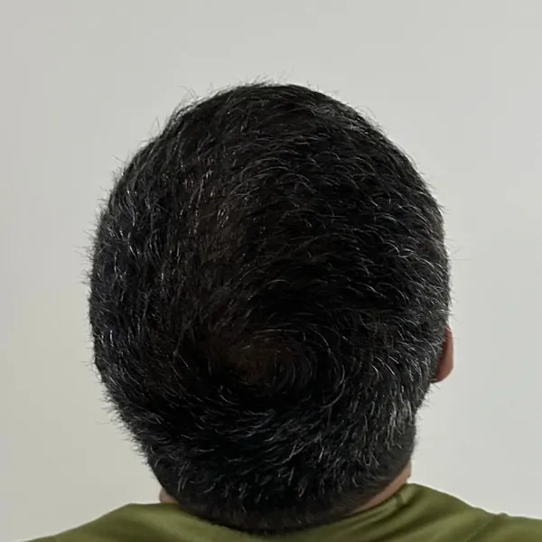 Tratamento para calvície — depois