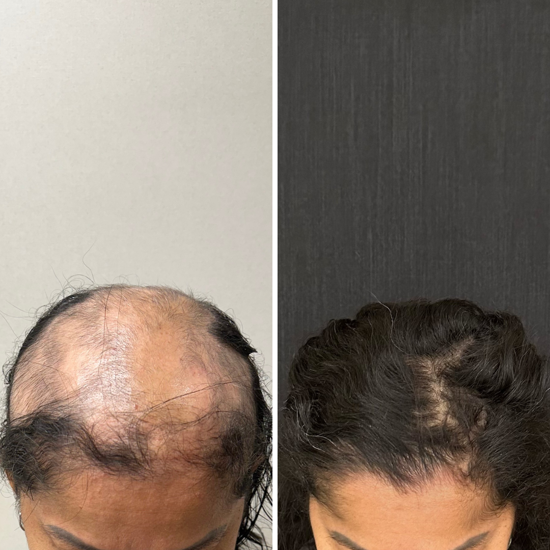 Resultado de tratamento capilar 9 — antes e depois