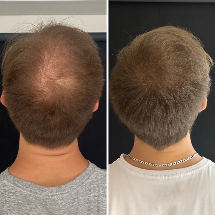 Resultado de tratamento capilar 10 — antes e depois