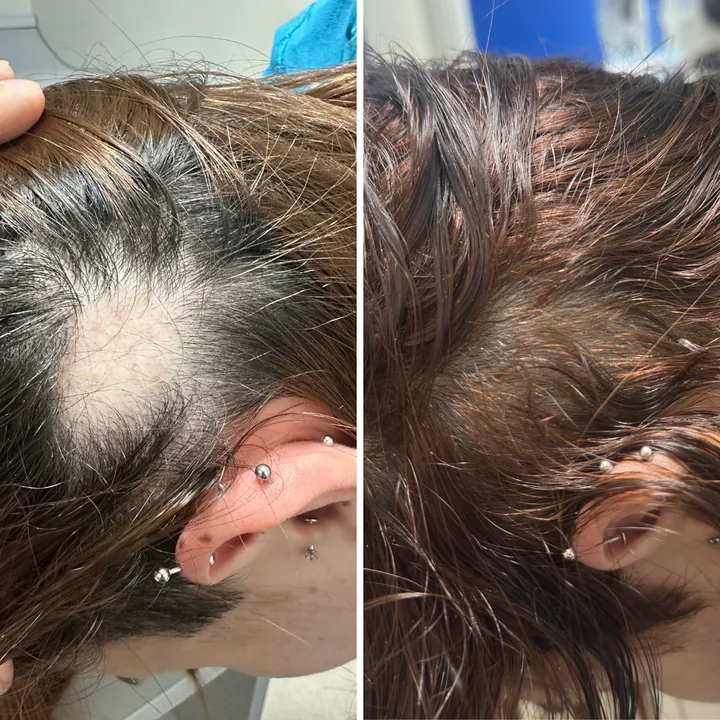 Resultado de tratamento capilar 11 — antes e depois