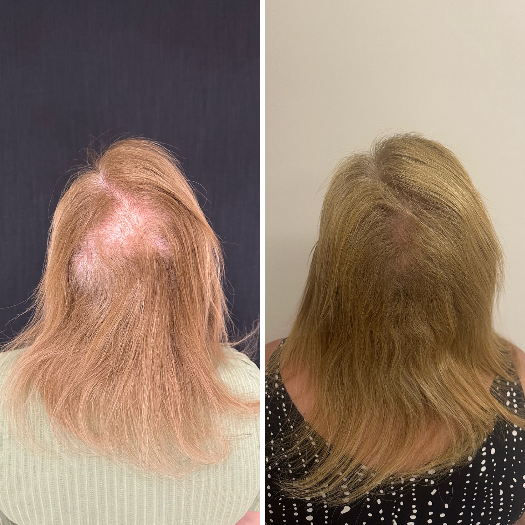 Resultado de tratamento capilar 13 — antes e depois