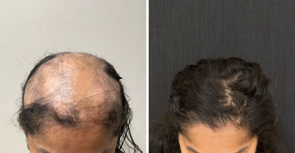 Duas fotos do couro cabeludo de pacientes com alopecia areata, com falhas e rarefação dos fios