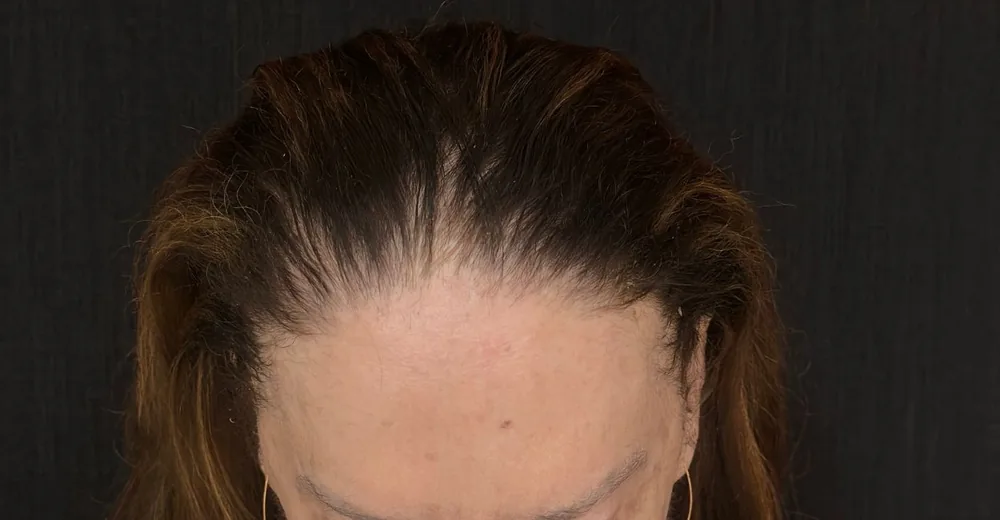 Vista de cima da linha do cabelo recuada e afinada na região frontal, em paciente com alopecia fibrosante frontal