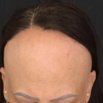 Alopecia fibrosante frontal: por que a testa aumenta