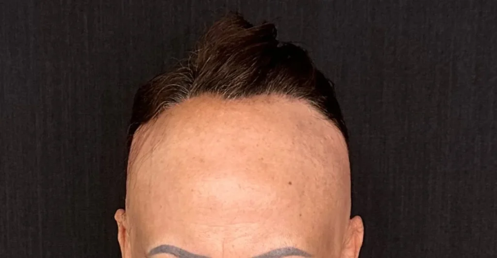 Testa com recuo da linha frontal do cabelo e perda das sobrancelhas, sinais da alopecia frontal fibrosante