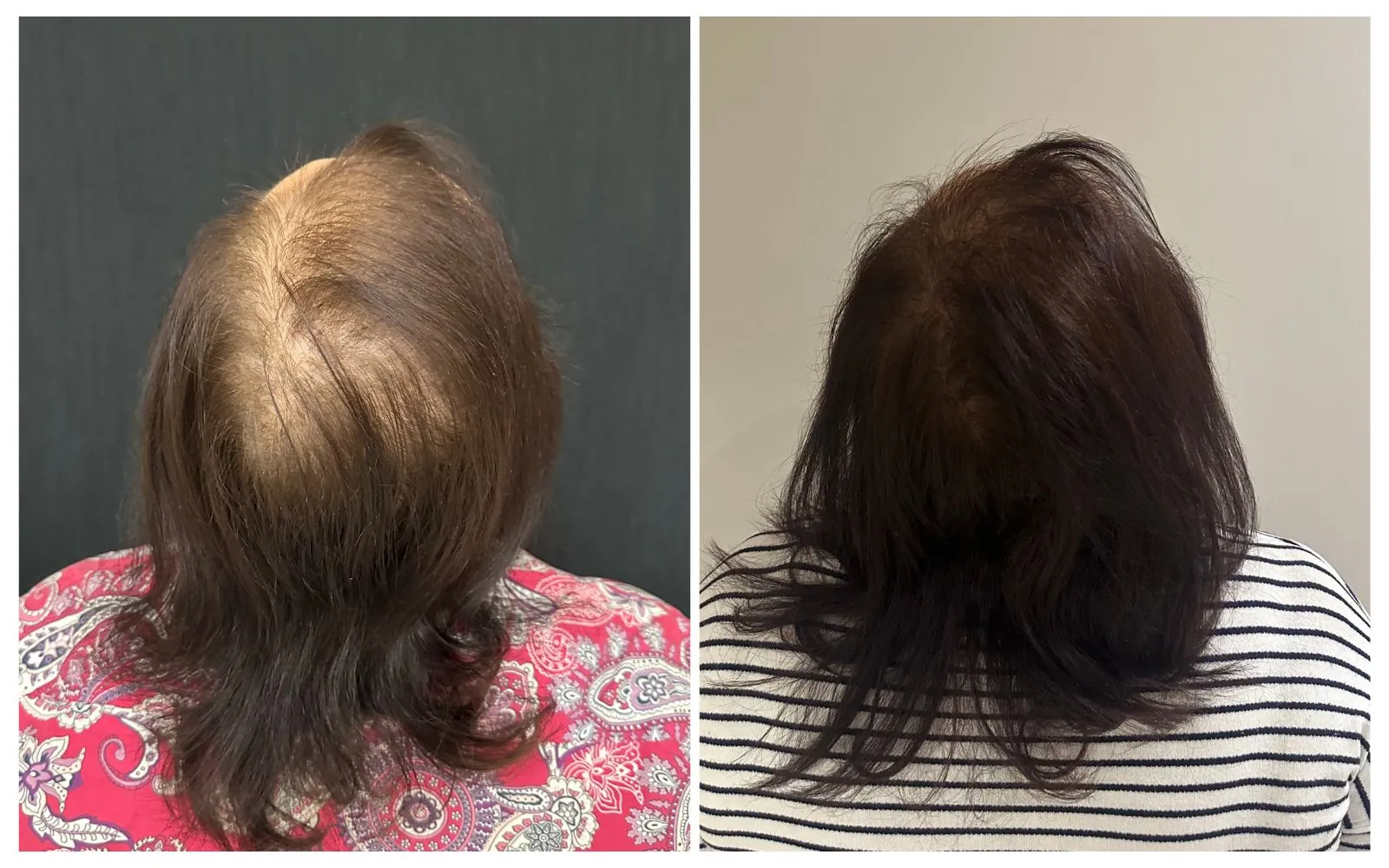 Vista de costas do cabelo de uma paciente, antes e depois