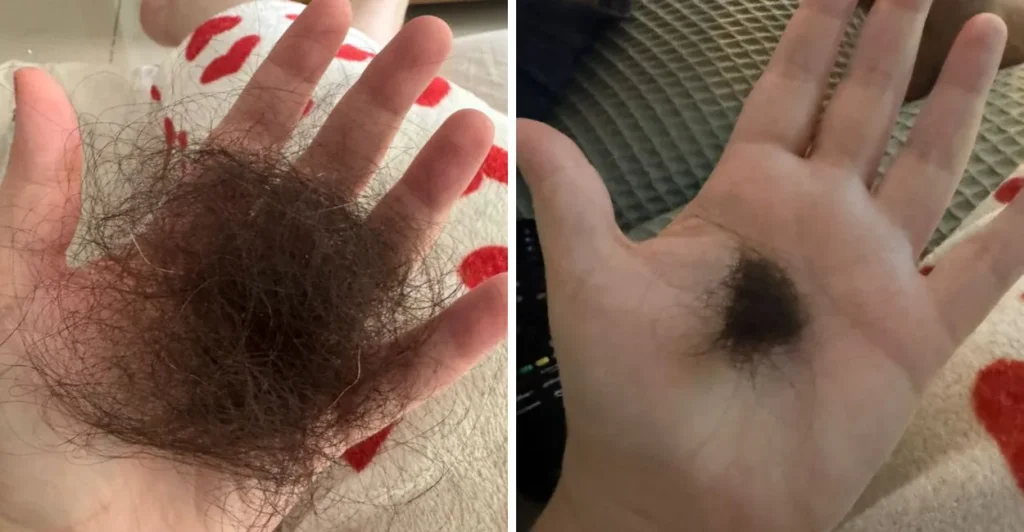 Duas mãos mostrando fios de cabelo que caíram, exemplo de queda de cabelo no eflúvio telógeno
