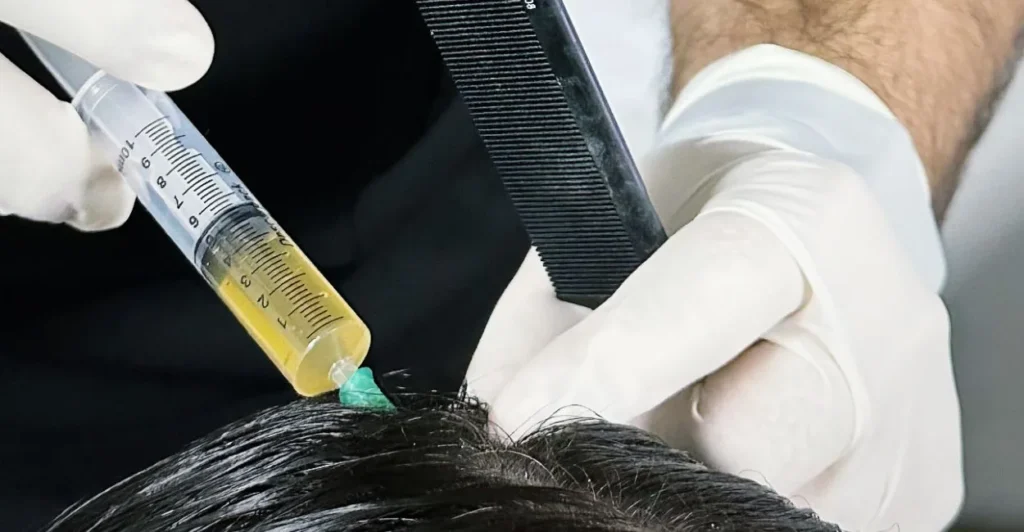 Mesoterapia capilar: aplicação de medicamento com seringa no couro cabeludo, em mãos com luvas