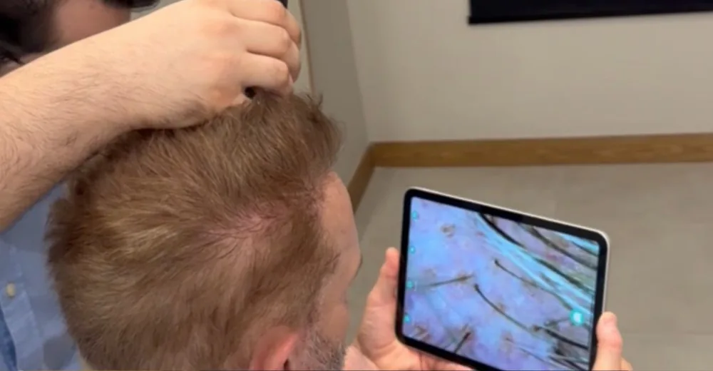 Tricoscopia no acompanhamento do pós transplante capilar, com imagem ampliada dos fios e do couro cabeludo em um tablet