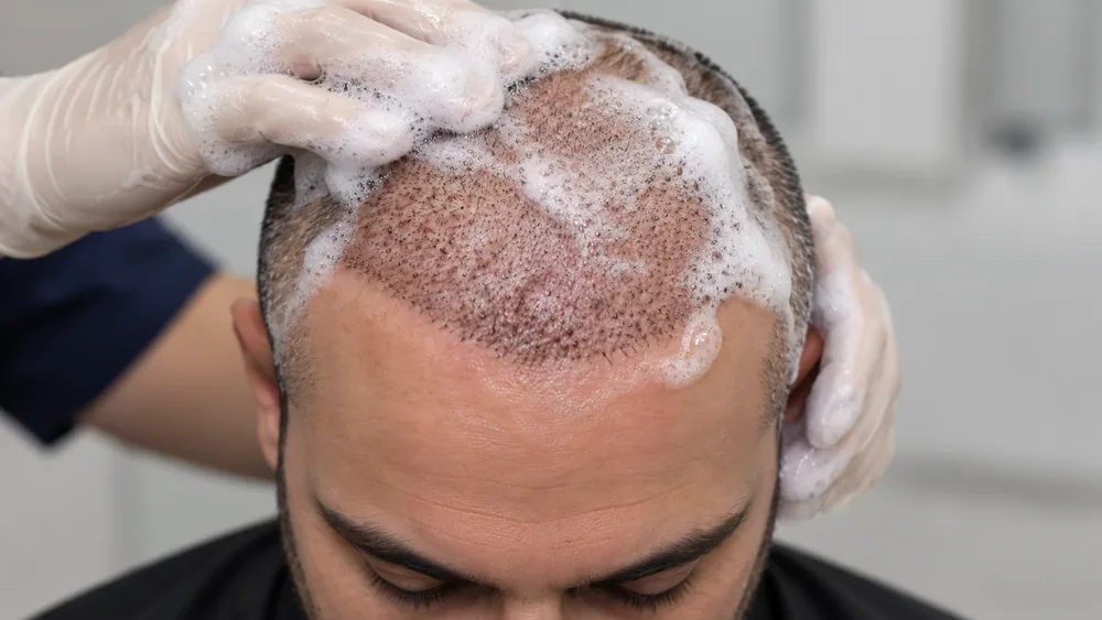 Lavagem delicada do couro cabeludo no pós transplante capilar, feita com luvas e espuma, conforme orientação médica