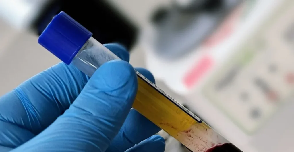 Tubo de coleta com plasma e sangue do próprio paciente para a terapia regenerativa capilar