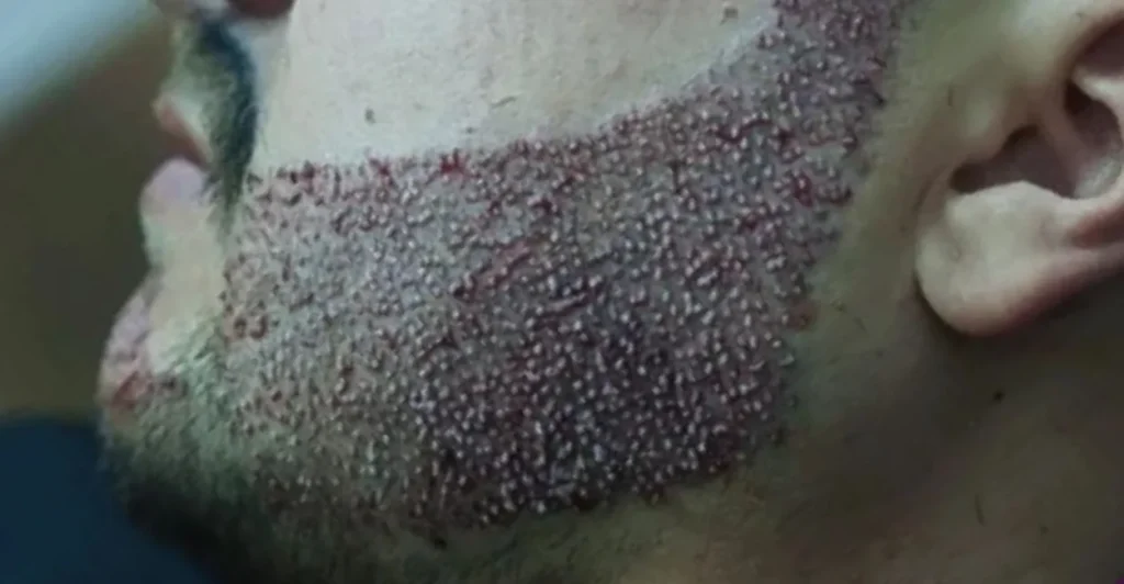 Região da barba logo após o transplante de barba, com os folicúlos implantados