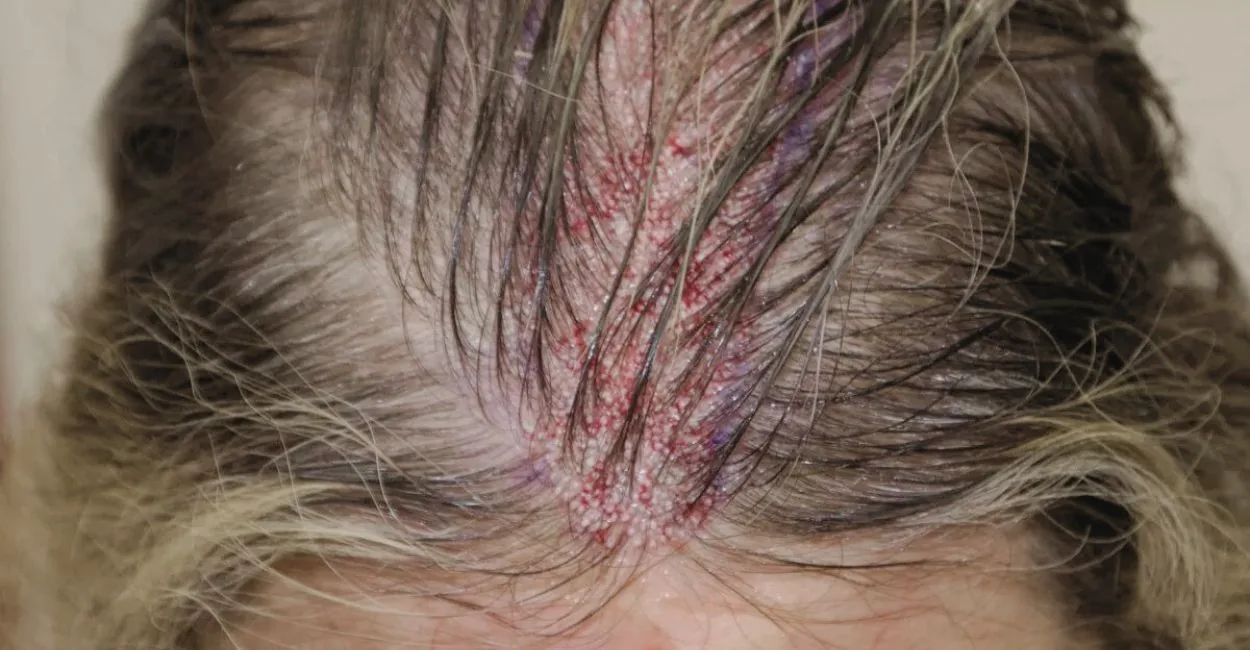 Região frontal do couro cabeludo de uma mulher logo após o transplante capilar feminino, com os folicúlos implantados