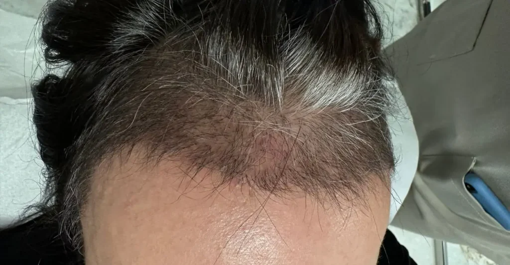 Linha frontal do cabelo de uma mulher, vista de cima, em consulta de transplante capilar feminino