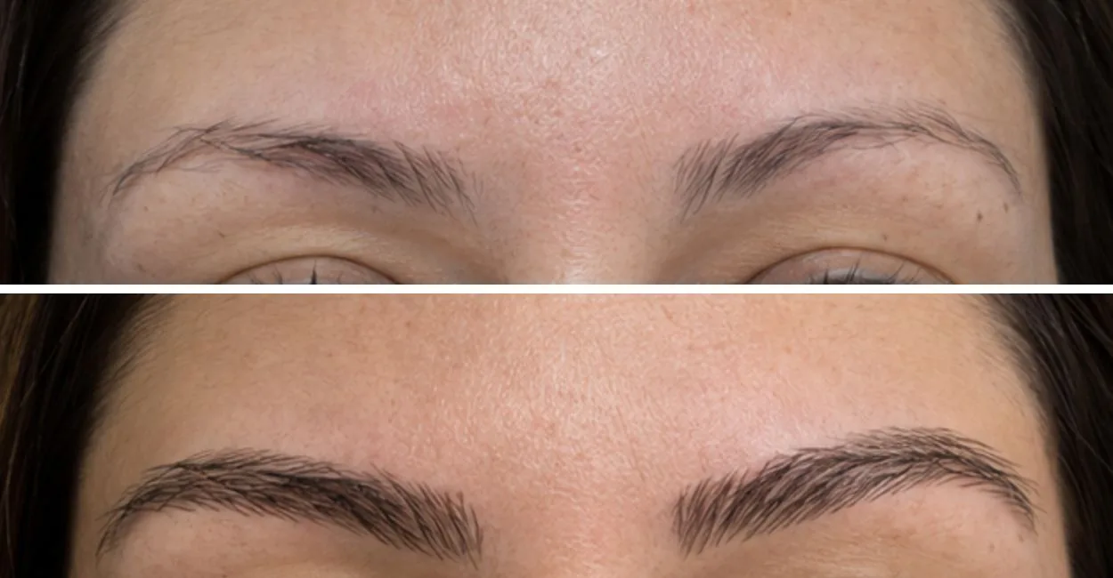 Sobrancelhas com poucos fios na imagem de cima e mais preenchidas na imagem de baixo, antes e depois do procedimento