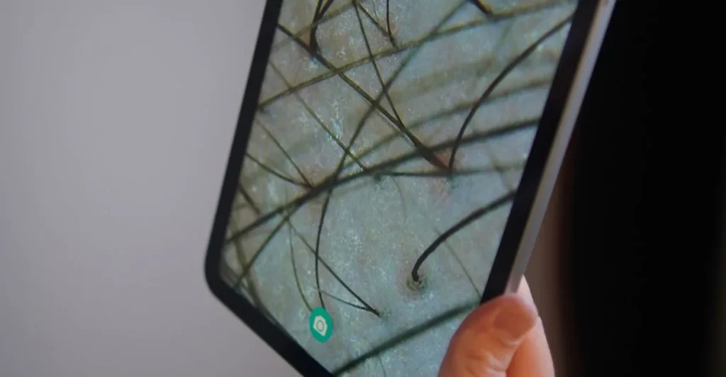 Imagem de tricoscopia do couro cabeludo e dos fios, ampliada na tela de um tablet durante a consulta